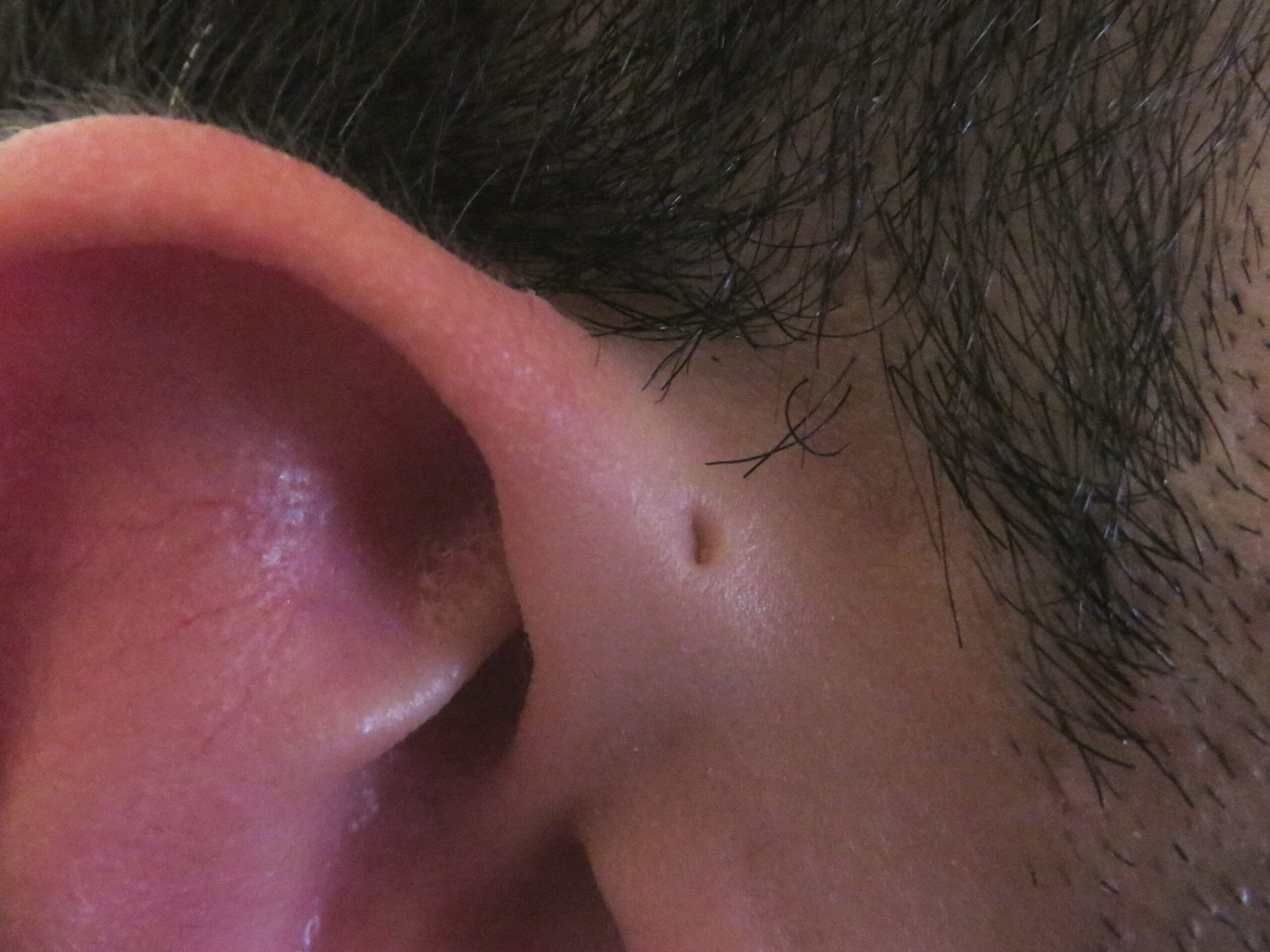 The Biblical Significance of the Preauricular Sinus