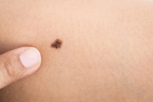 What do Birthmarks Mean in the Bible?