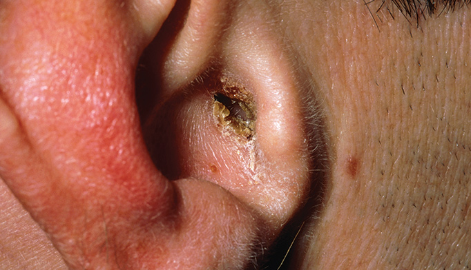 Discover the Spiritual Significance Behind Ear Infections