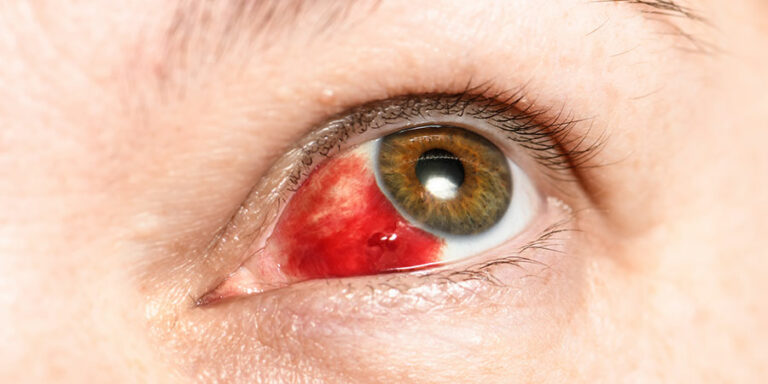 What is a broken blood vessel in the eye?