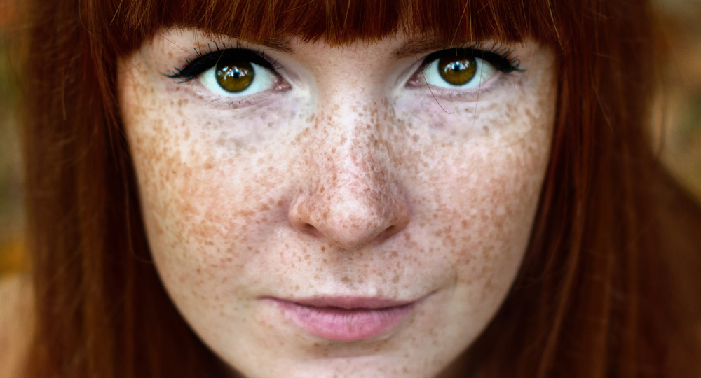 What are Freckles and How Do They Form on the Skin?